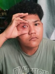 Miris!!! Seorang Siswa SMKN 5 Mengalami Cidera Bagian Mata Saat PKL di PT.Bluebird